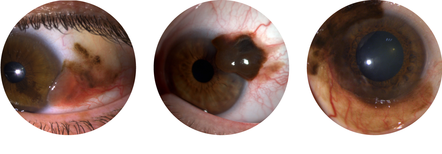 Mélanome conjonctival suivant son origine