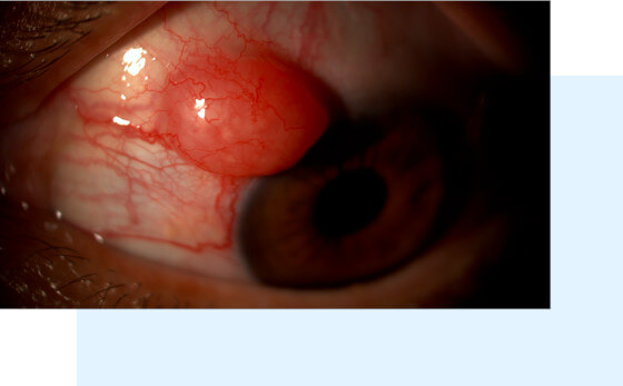 Cancer de l'oeil, tumeur conjonctivale - doon