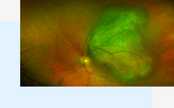Cancer de l'oeil, tumeur intraoculaire - doon